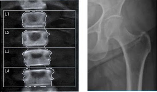 Bone Health Figure 1. Representative lumbar spine (left) and hip (right) DXA.14