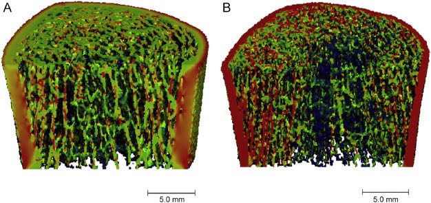 Bone Health Figure 3. Representative HR-pQCT images of the tibia of a 23-year-old healthy woman (A) and a 23-year-old woman with CF (B)
