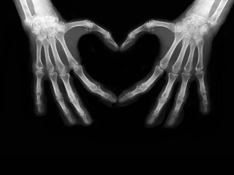 Bone Health in Cystic Fibrosis