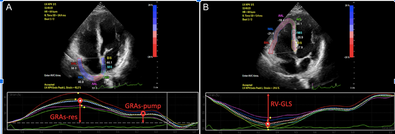 Figure 1. Right ventricular global longitudinal strain (RV GLS), global longitudinal right atrial strain during ventricular systole